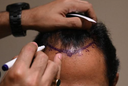 Menemukan Rambut Baru Dengan Hair Transplant di Indonesia, Tak Harus Ke Turki